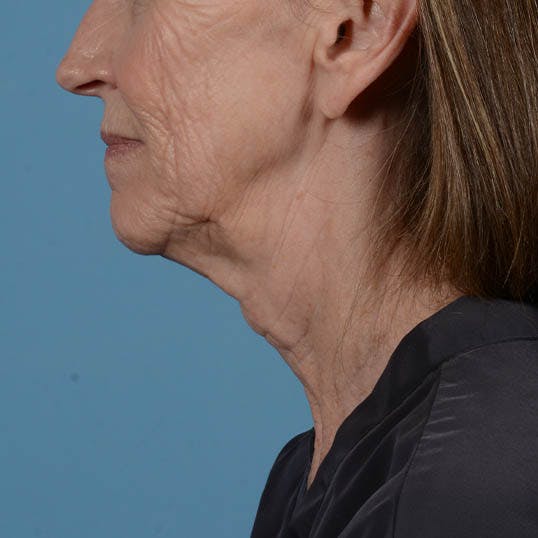 Facelift Before & After Gallery - Patient 353540 - Image 11