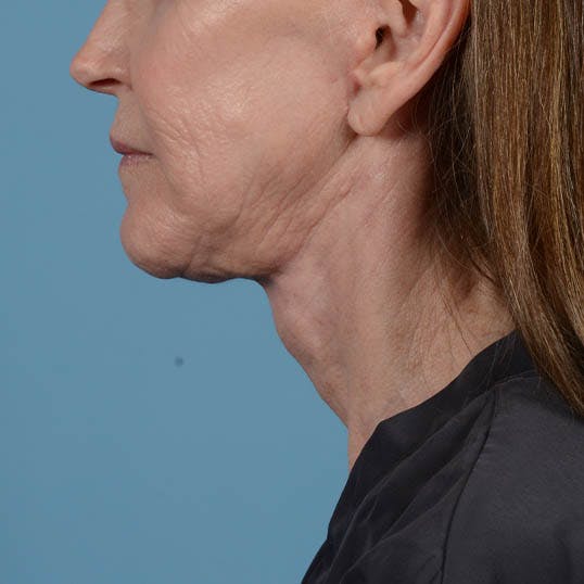 Facelift Before & After Gallery - Patient 353540 - Image 12