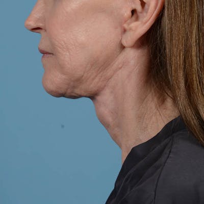 Facelift Before & After Gallery - Patient 353540 - Image 12