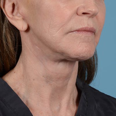 Facelift Before & After Gallery - Patient 353540 - Image 14