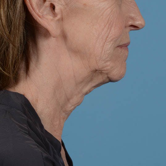 Facelift Before & After Gallery - Patient 353540 - Image 15