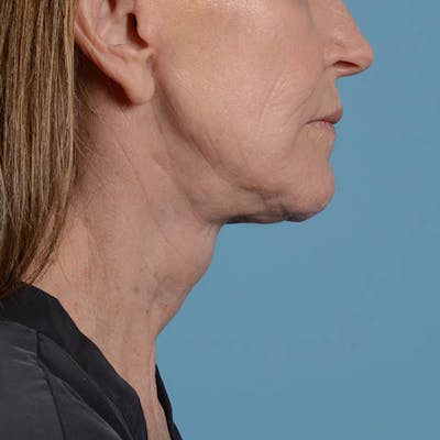 Facelift Before & After Gallery - Patient 353540 - Image 16