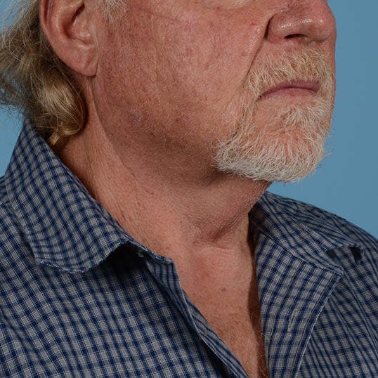 Facelift Before & After Gallery - Patient 363383 - Image 1