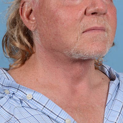 Facelift Before & After Gallery - Patient 363383 - Image 2