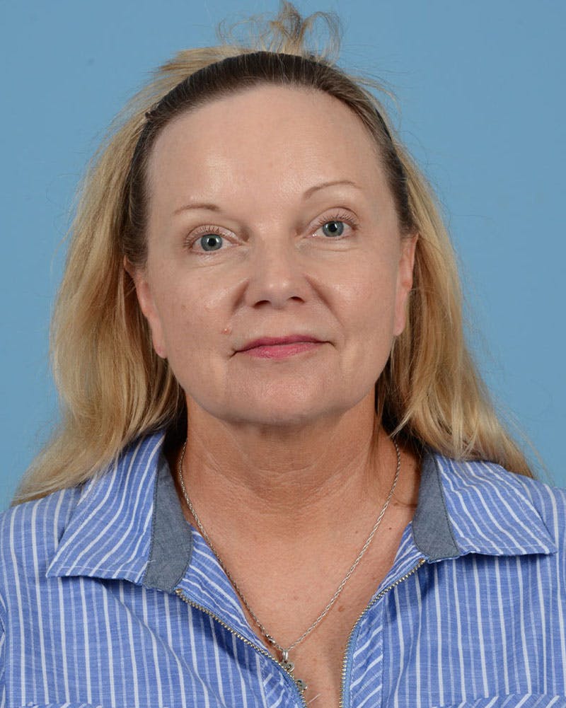 Facelift Before & After Gallery - Patient 136087 - Image 1