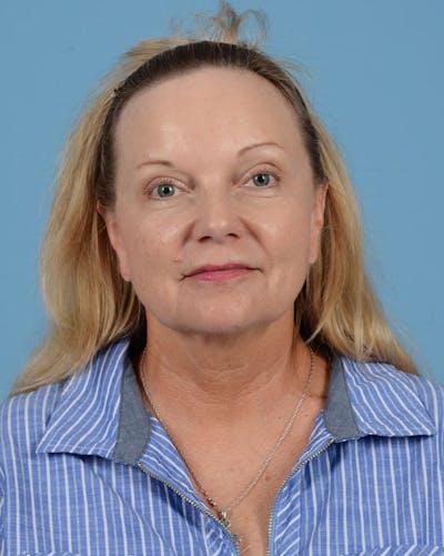 Facelift Before & After Gallery - Patient 136087 - Image 1