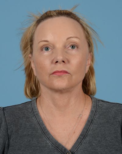 Facelift Before & After Gallery - Patient 136087 - Image 2