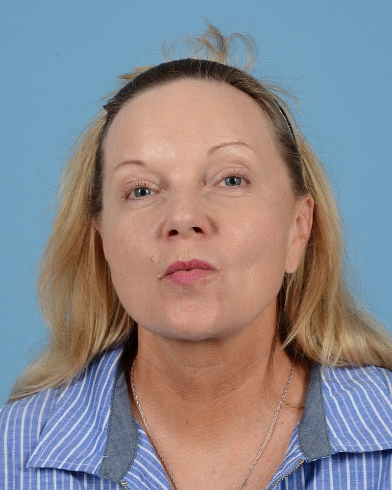 Facelift Before & After Gallery - Patient 136087 - Image 3
