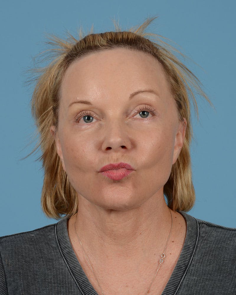 Facelift Before & After Gallery - Patient 136087 - Image 4