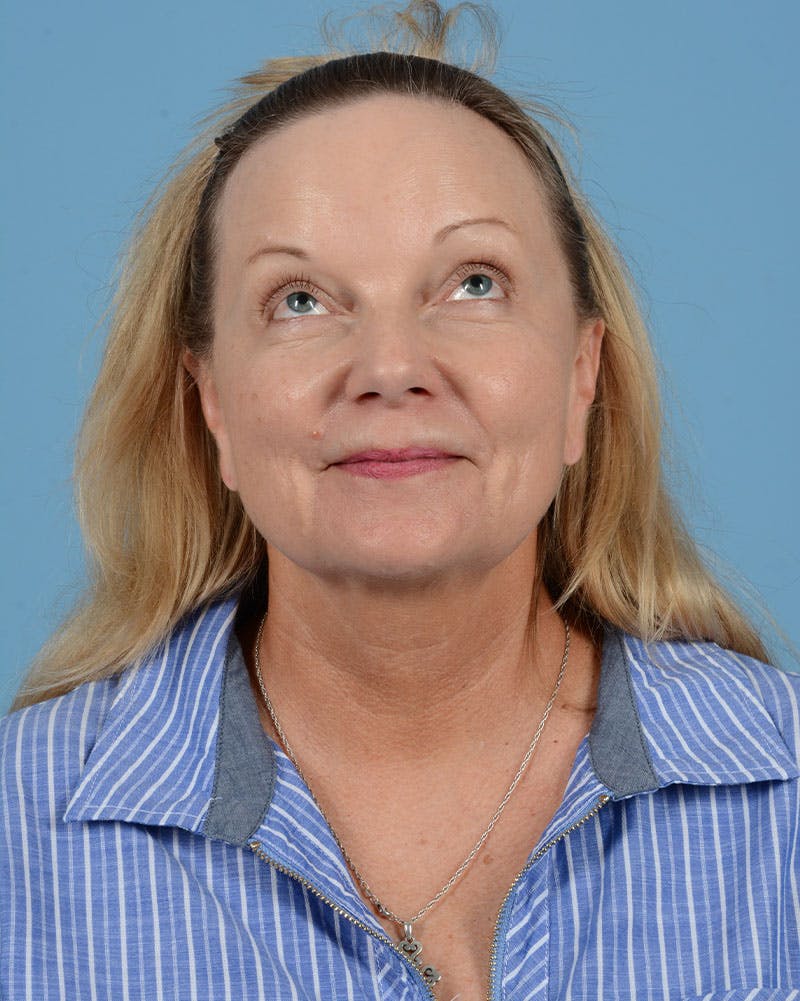 Facelift Before & After Gallery - Patient 136087 - Image 5