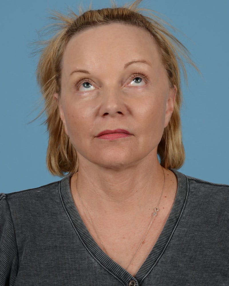 Facelift Before & After Gallery - Patient 136087 - Image 6