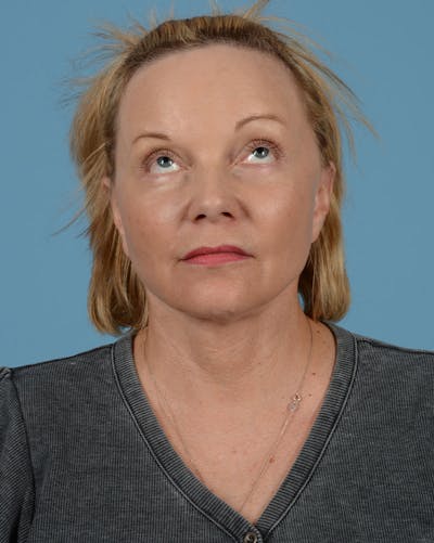 Facelift Before & After Gallery - Patient 136087 - Image 6