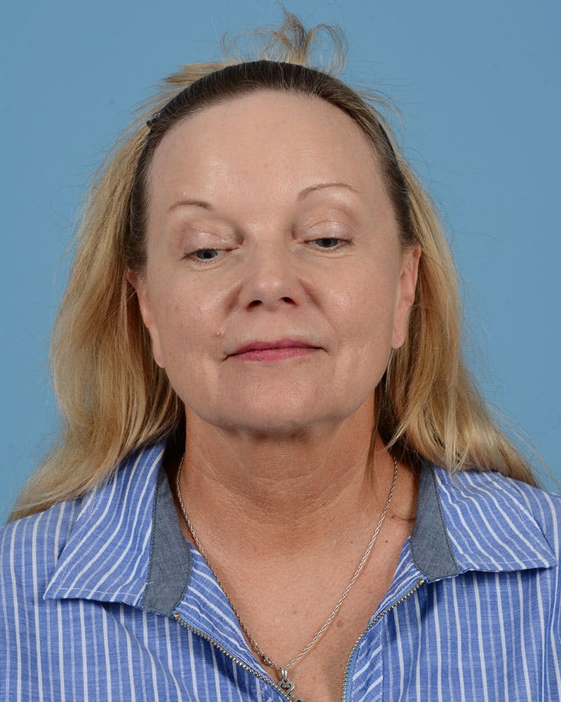 Facelift Before & After Gallery - Patient 136087 - Image 7