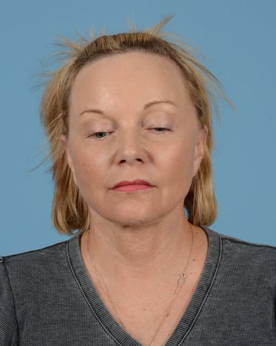 Facelift Before & After Gallery - Patient 136087 - Image 8