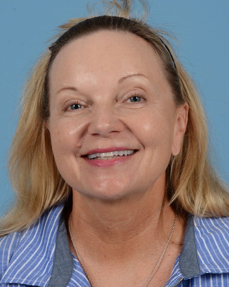 Facelift Before & After Gallery - Patient 136087 - Image 9