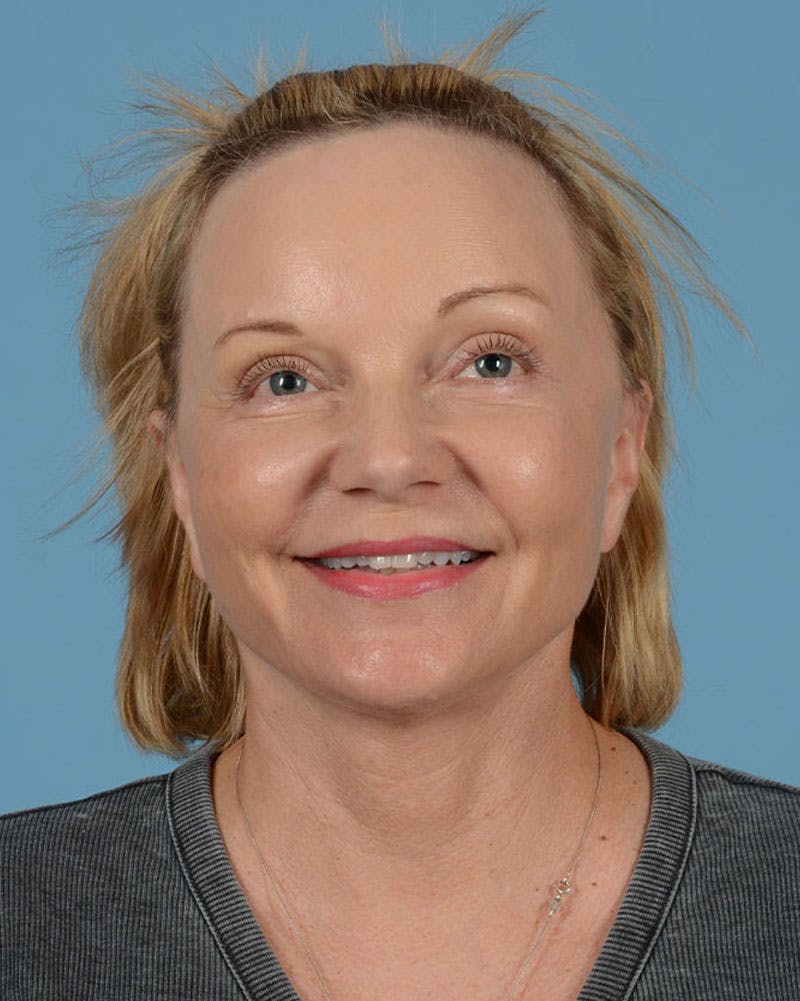 Facelift Before & After Gallery - Patient 136087 - Image 10