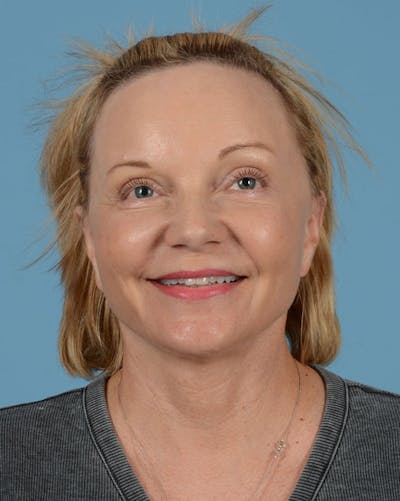 Facelift Before & After Gallery - Patient 136087 - Image 10