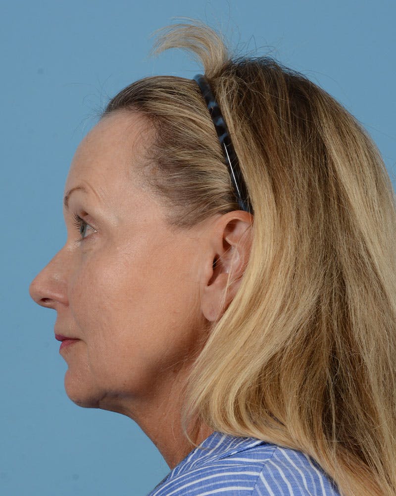 Facelift Before & After Gallery - Patient 136087 - Image 11