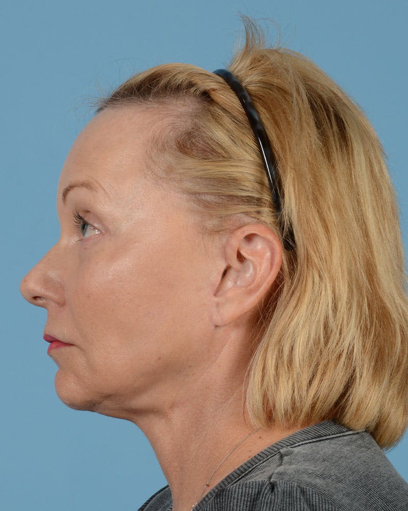 Facelift Before & After Gallery - Patient 136087 - Image 12