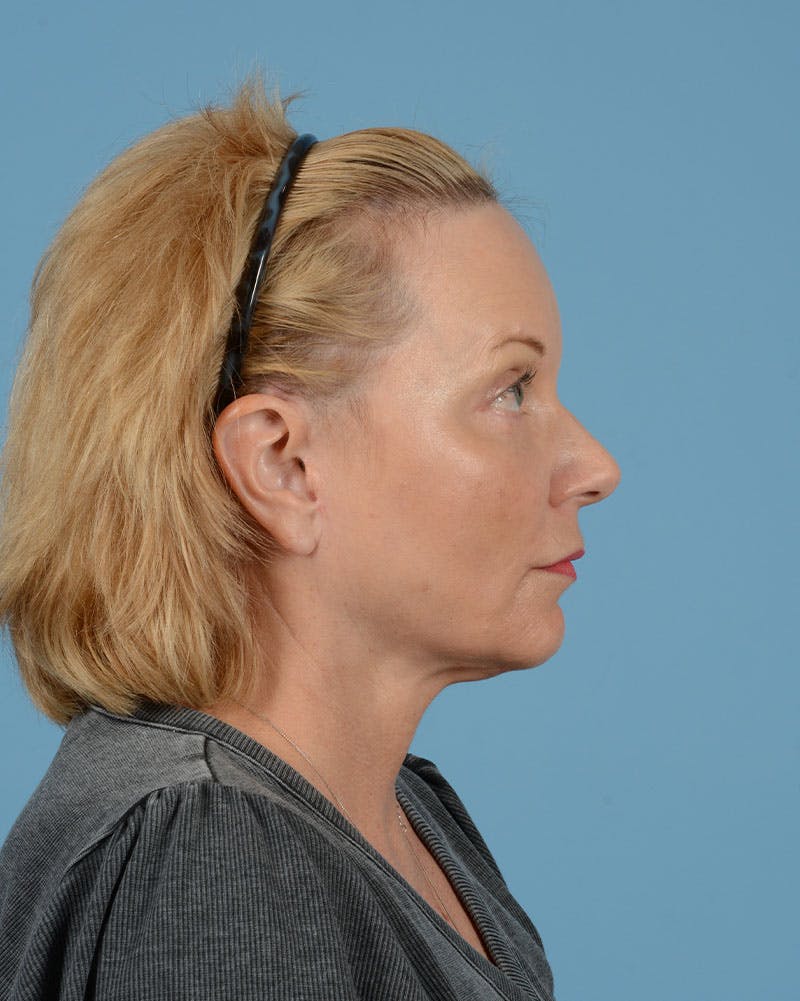 Facelift Before & After Gallery - Patient 136087 - Image 14