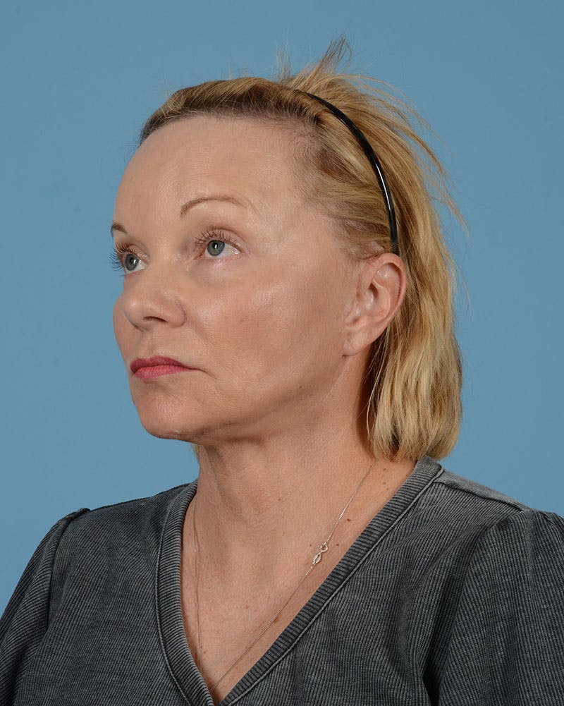 Facelift Before & After Gallery - Patient 136087 - Image 16