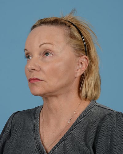 Facelift Before & After Gallery - Patient 136087 - Image 16
