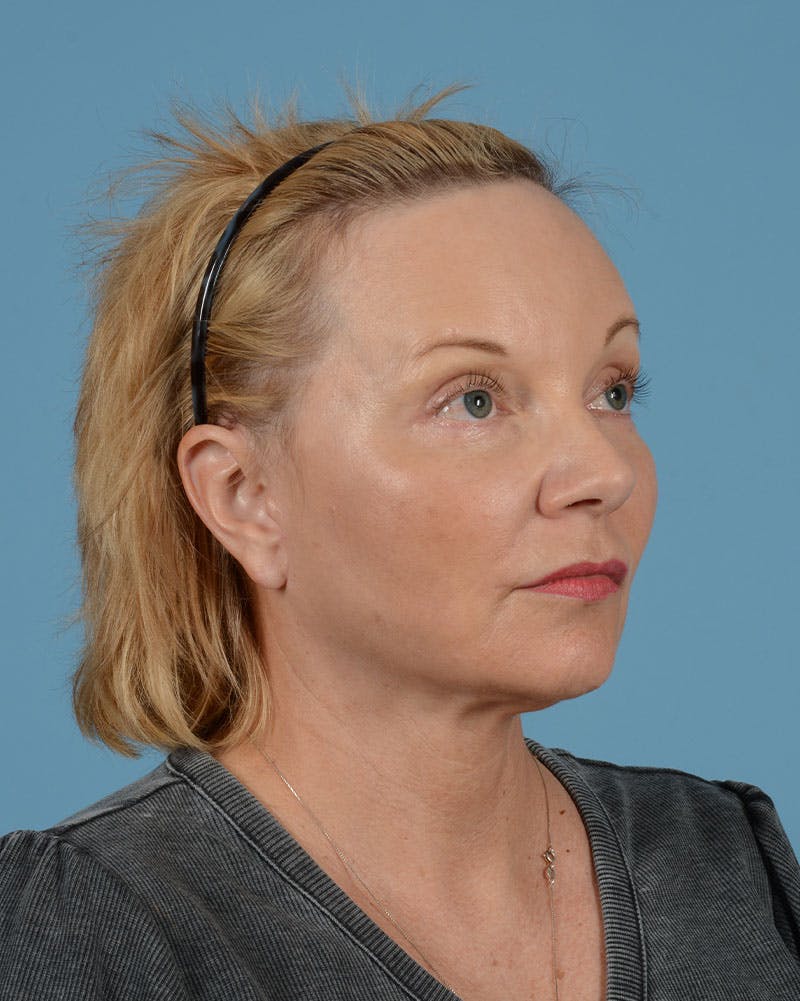 Facelift Before & After Gallery - Patient 136087 - Image 18