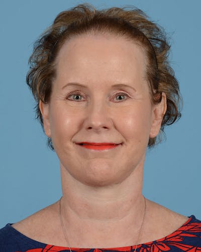 Facelift Before & After Gallery - Patient 218064 - Image 2