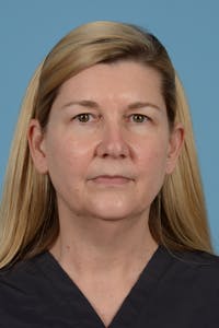 Facelift Before & After Gallery - Patient 293480 - Image 1