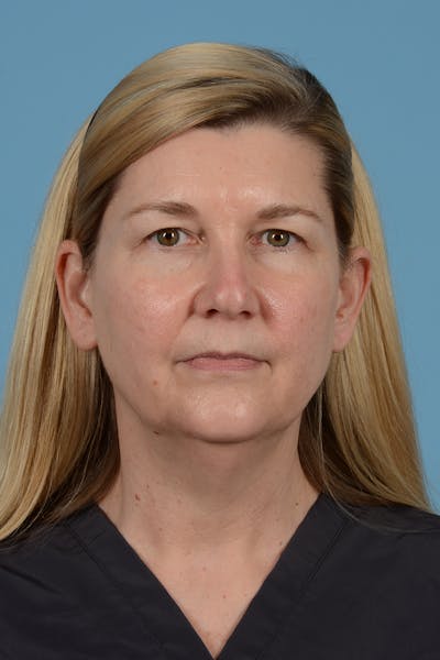 Facelift Before & After Gallery - Patient 293480 - Image 1