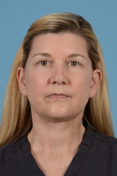 Facelift Before & After Gallery - Patient 293480 - Image 2