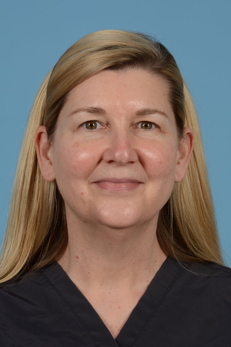 Facelift Before & After Gallery - Patient 293480 - Image 3