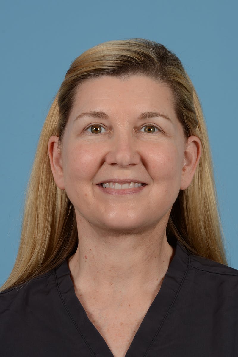 Facelift Before & After Gallery - Patient 293480 - Image 4
