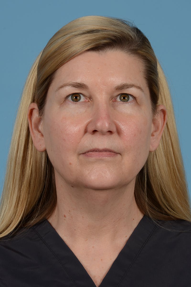 Facelift Before & After Gallery - Patient 293480 - Image 5
