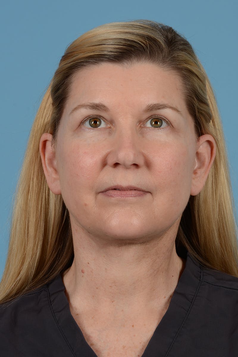 Facelift Before & After Gallery - Patient 293480 - Image 6