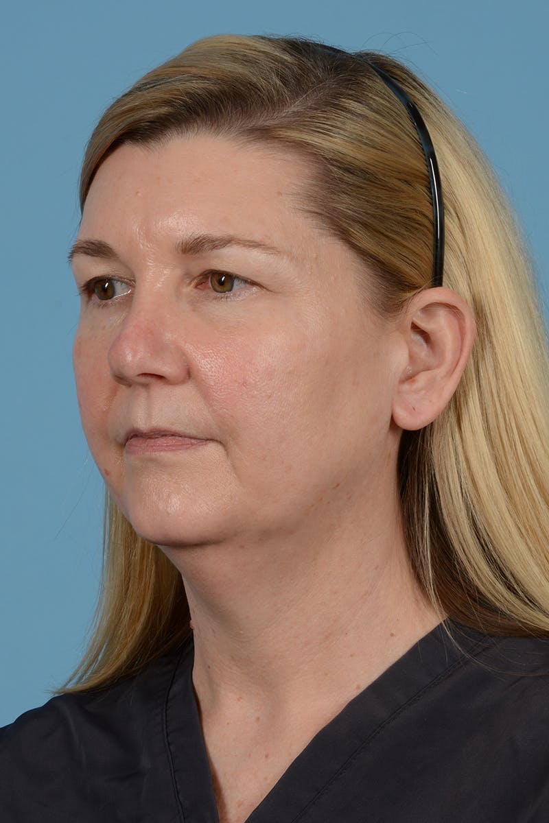 Facelift Before & After Gallery - Patient 293480 - Image 7