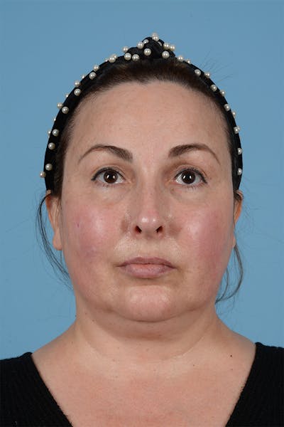 Facelift Before & After Gallery - Patient 298047 - Image 1