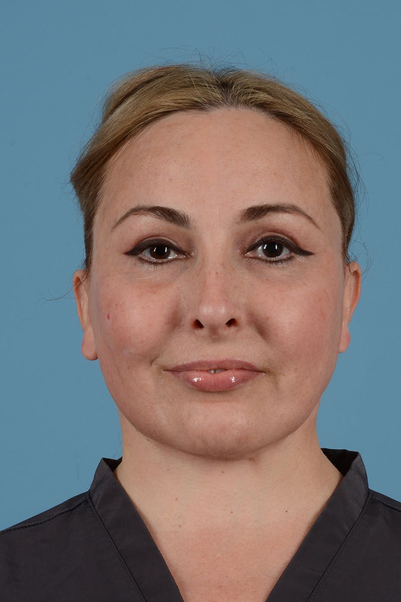 Facelift Before & After Gallery - Patient 298047 - Image 4