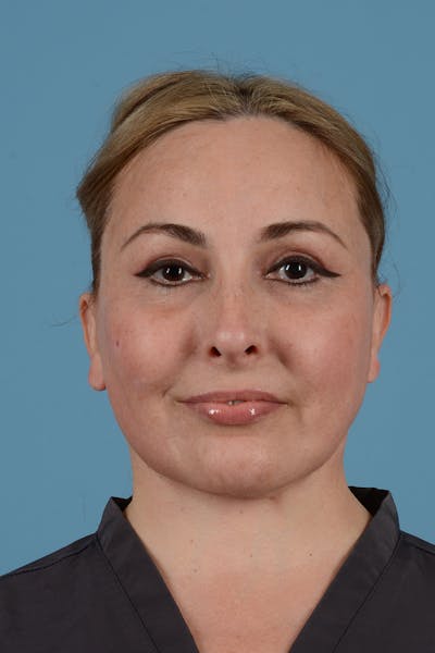 Facelift Before & After Gallery - Patient 298047 - Image 4