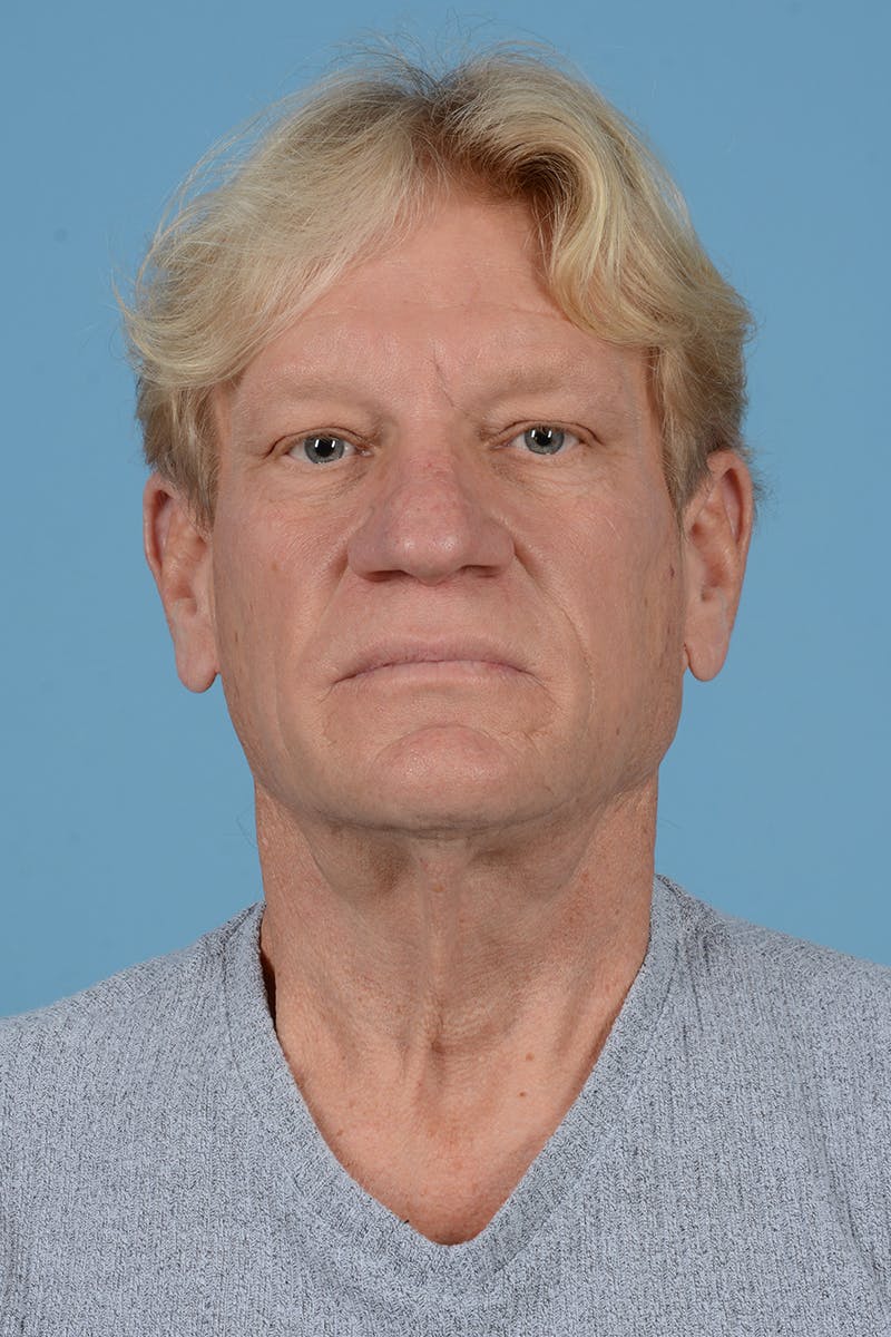 Facelift Before & After Gallery - Patient 259212 - Image 1