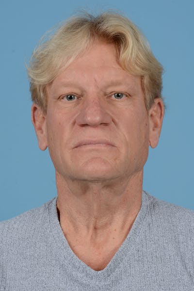 Facelift Before & After Gallery - Patient 259212 - Image 1