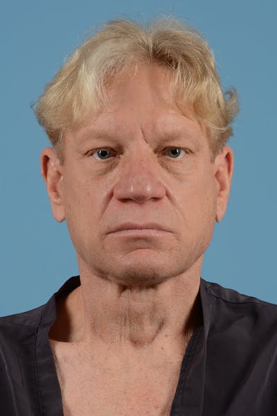 Facelift Before & After Gallery - Patient 259212 - Image 2