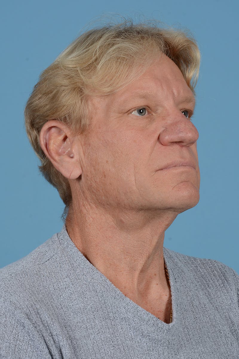 Facelift Before & After Gallery - Patient 259212 - Image 3