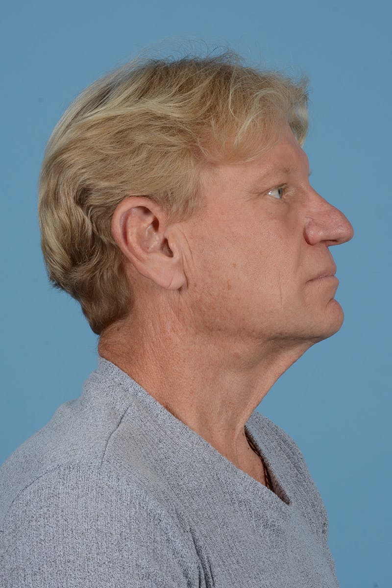 Facelift Before & After Gallery - Patient 259212 - Image 5