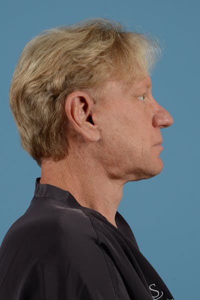 Facelift Before & After Gallery - Patient 259212 - Image 6