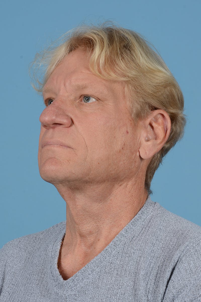 Facelift Before & After Gallery - Patient 259212 - Image 7