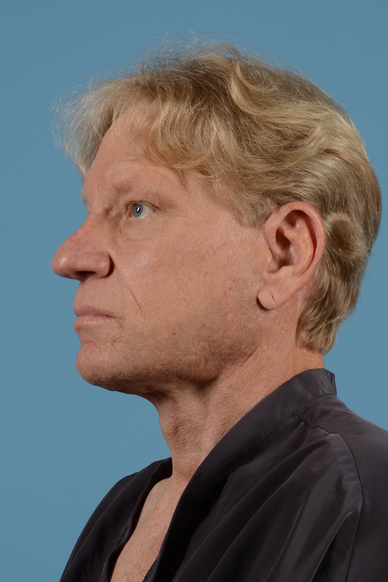 Facelift Before & After Gallery - Patient 259212 - Image 8