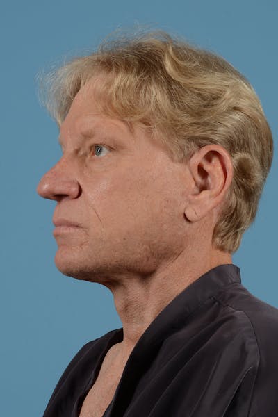 Facelift Before & After Gallery - Patient 259212 - Image 8