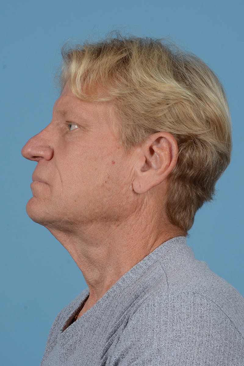 Facelift Before & After Gallery - Patient 259212 - Image 9