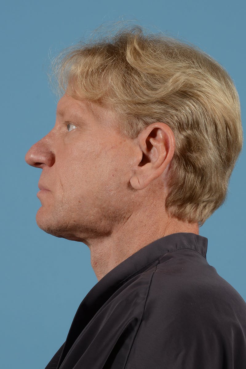 Facelift Before & After Gallery - Patient 259212 - Image 10